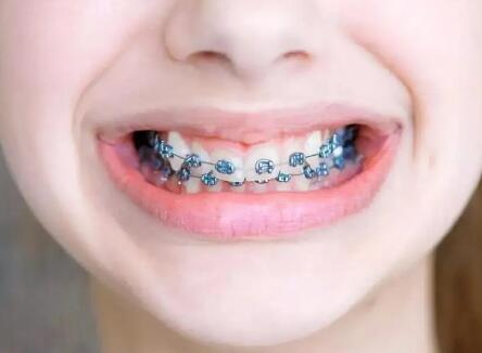 固定牙套会不会对牙齿造成伤害(固定牙套的优缺点)