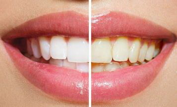 4种方法让您的素牙变得雪白_四环素牙怎么变白小窍门
