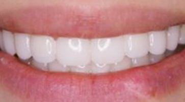 经常剔牙导致牙齿松动和疼痛(经常剔牙导致牙缝隙大牙齿位移)