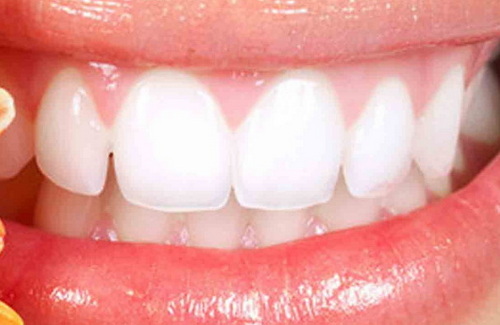 有戴在牙齿内侧的矫正器_泉州哪里可以洗牙齿