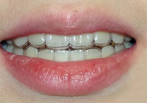 牙齿贴面解决牙突的方法(牙齿贴面咬合怎么解决的)