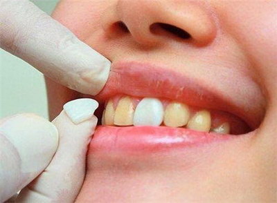 镶牙多久后才能跟正常牙一样_牙齿拔了需要多久才能镶牙