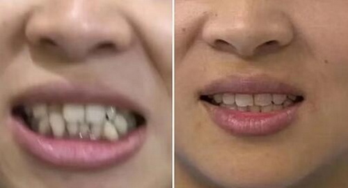 金属种植牙对身体的伤害