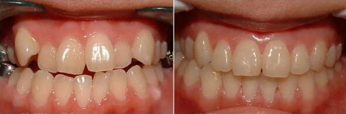 牙齿矫正磨牙有危害吗