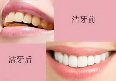 四环素牙美白方法