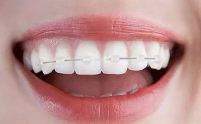牙齿的正畸方法(正畸牙齿的方法)