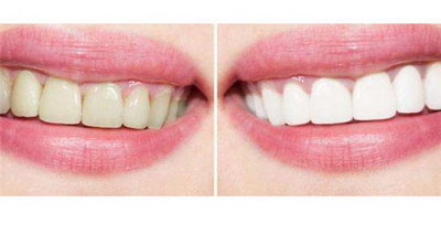 冷光美白牙齿的特别是什么？