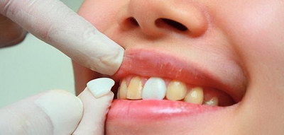 一颗牙齿做牙冠修复需要多长时间