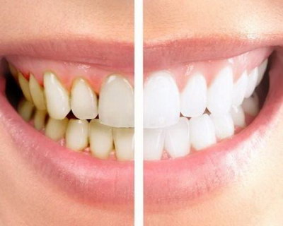烤瓷牙可以矫正牙齿吗?——关于龅牙的治疗方法