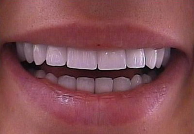 固定假牙厚牙龈萎缩