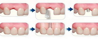 种植牙修复收费(什么是种植牙修复？)