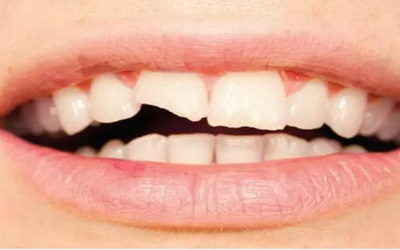 牙齿种植需要几次手术(牙齿种植需要几次手术)