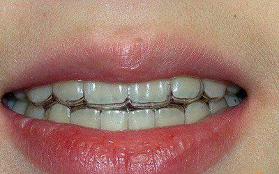怎样保护牙齿健康(保护牙齿健康的小窍门)