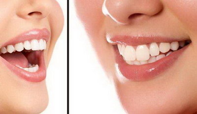 牙龈萎缩可以种植牙(老年人牙龈萎缩可以种植牙吗)