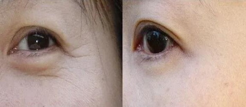 双眼皮做完多长时间能用洗面奶_双眼皮做完多长时间能正常
