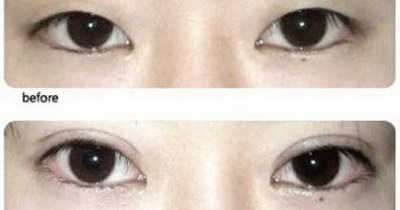 单眼皮双眼皮遗传图