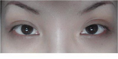 双眼皮出现肉条感的原因(什么是双眼皮肉条？)