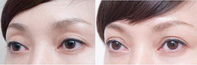 眼角出血多长时间能恢复_双眼皮和开眼角可以同时进行吗