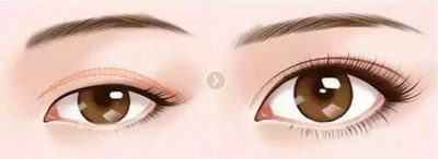 微创双眼皮术就是韩式三点双眼皮吗？