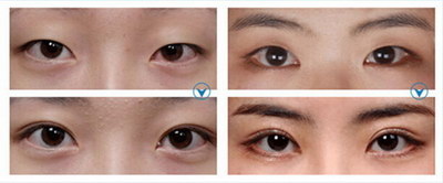 外切祛眼袋可以综合的改善眼袋？