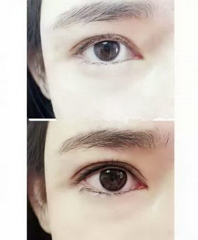 韩式双眼皮让你拥有自然大眼睛