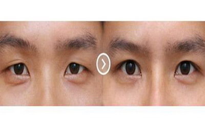 近视眼睛手术有副作用吗