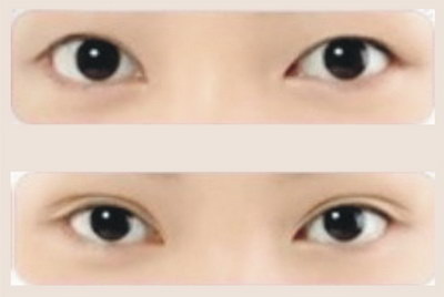 手术双眼皮适合的年龄_怎么从内双变成双眼皮