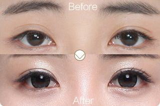 双眼皮修复的种类有哪几种类型