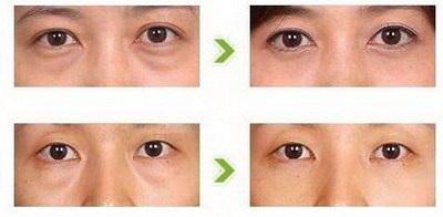 关于双眼皮手术的恢复期
