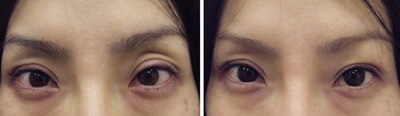 眼部有斑怎么能让眼妆更干净
