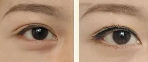做双眼皮用鸡蛋敷眼睛的正确方法_做双眼皮眼睛充血怎么快速消除啊