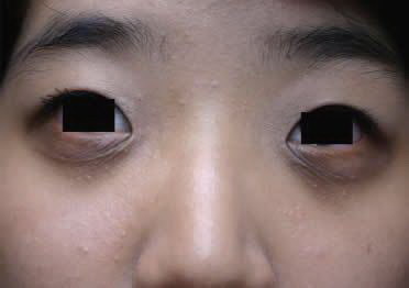 全切双眼皮一个月宽度定型了吗(什么是全切双眼皮？)