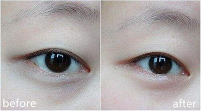 埋线双眼皮淤紫:有哪些治疗方法能让它们很快退去?