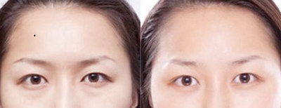 北京八大处双眼皮手术(北京八大处的双眼皮手术有哪些特色?)