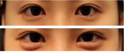 眼底检查能查出所有的眼部疾病吗