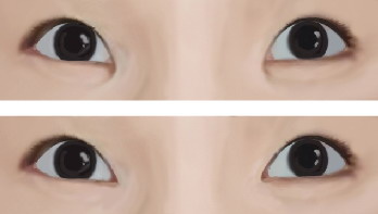 怎么能从单眼皮变成双眼皮的方法_广州双眼皮手术哪间医院好些
