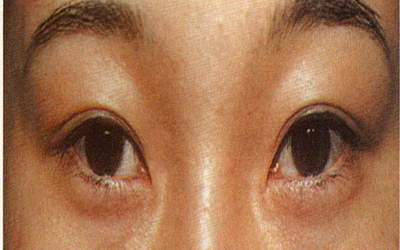 做完双眼皮眼睛流泪为多长时间能好(如何让眼皮手术后的流泪快速消退？)