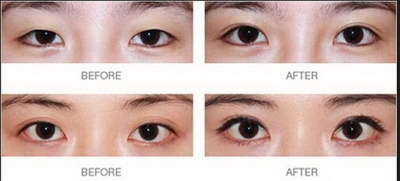 杭州做双眼皮整容医院最好(为什么杭州做双眼皮整容选取优先选取医院？)