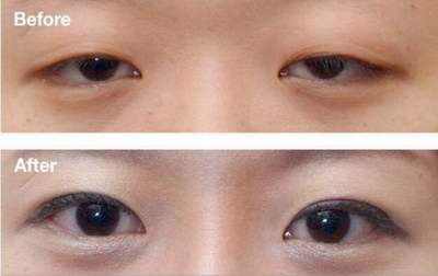 双眼皮手术变成了三眼皮正常吗(不手术怎么变成双眼皮)
