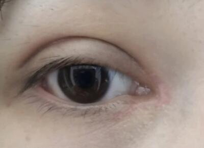 眼部周围长了很多红色的小疹子_如何眼部运动可以使眼轴变短
