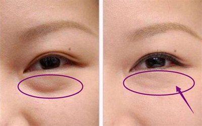 微创双眼皮手术多久恢复元气_微创双眼皮手术的副作用