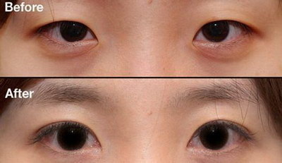 做双眼皮疤痕膏怎么使用_做双眼皮多久能做近视眼手术