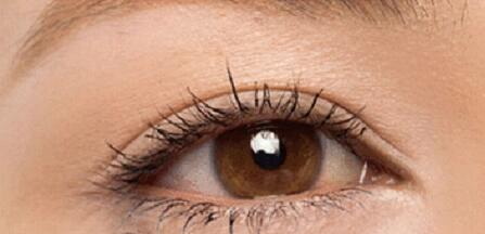 全切双眼皮要多久才能恢复正常_全切双眼皮失败后多久可以修复