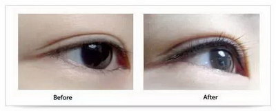 做完近视眼手术多久可以纹眼线