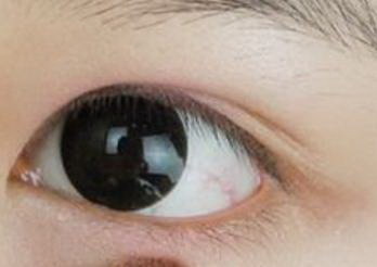 如何彻底治疗黑眼圈_如何治疗黑眼圈和眼袋的方法