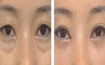 双眼皮全切和韩式三点区别(全切双眼皮和韩式三点区别)