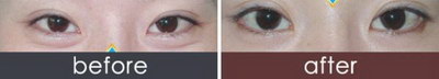 眼睛红红的像出血一样是怎么回事_眼睛黑眼圈怎么去除最快最有效