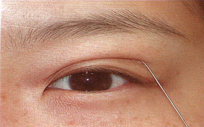 埋线双眼皮多久定型不变了_埋线双眼皮恢复多久定型