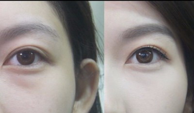 双眼皮拆线后可以用眼霜吗_双眼皮拆线后恢复视频:这是一种可视化修复手术