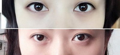 武汉韩式双眼皮手术